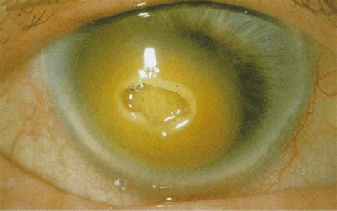 Image of a scarred cornea | Injury, Eyes, Scar