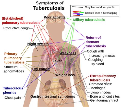 Tuberculosis (TB, Consumption) — Diagnosis and Treatment