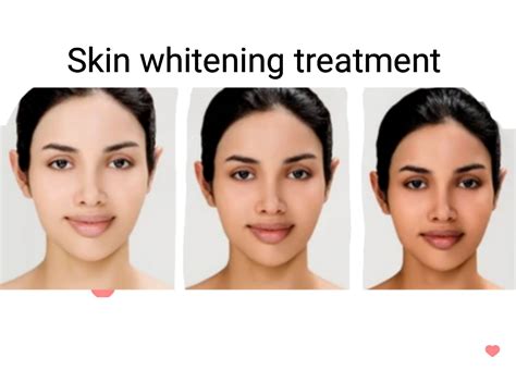 Skin whitening injections