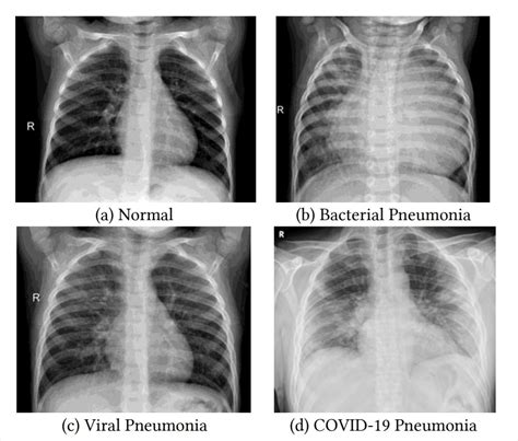 Chest X Ray Bronchitis Vs Pneumonia