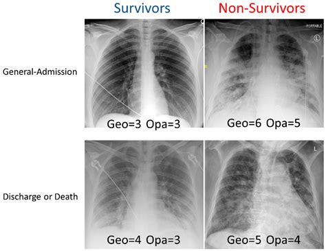 Chest X-ray Findings Monitoring COVID-19 Disease Course And, 50% OFF