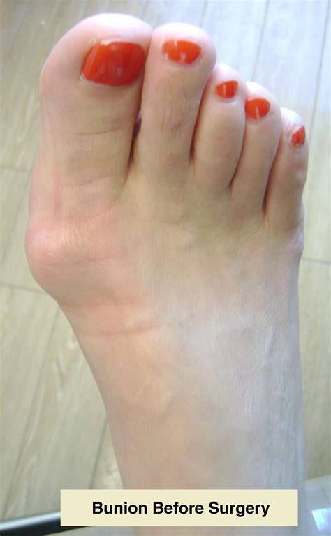 Bunions | Foot & Ankle Doctors, Inc.