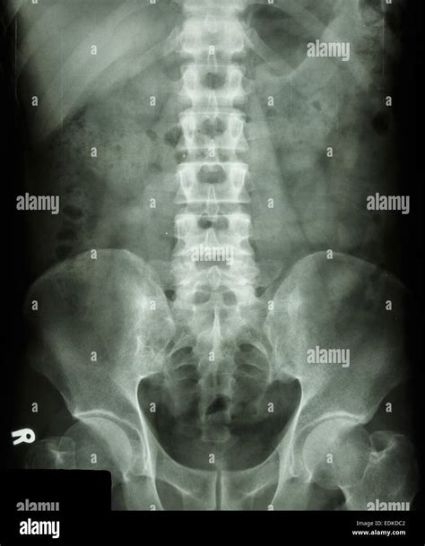 Normal Lumbosacral X Ray : Lateral lumbar radiographs. Left ...