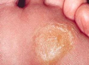 Callus - Perform Podiatry