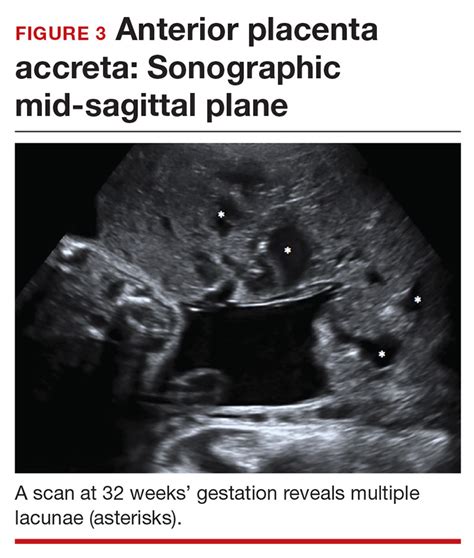 Placenta Accreta Mri