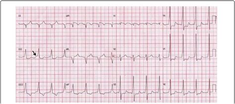 A 12-lead electrocardiogram during sinus rhythm with delta wave (shown ...