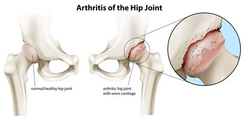 Hip Pain Treatment - Chiropractor in Nashville — Chiropractor Nashville ...