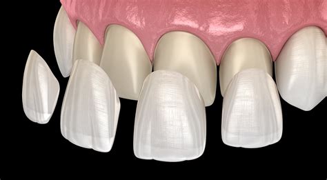 Dental veneers - Types, Uses & Process - Safar Medical