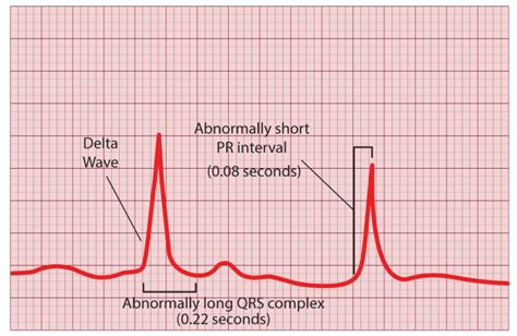 delta wave ecg