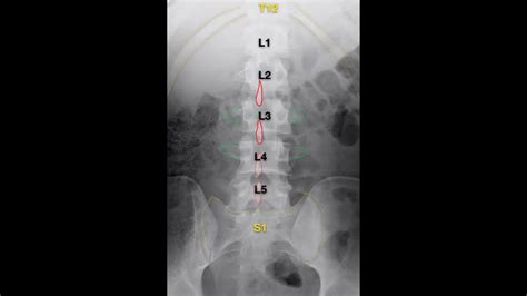 Lumbar Spine Xray