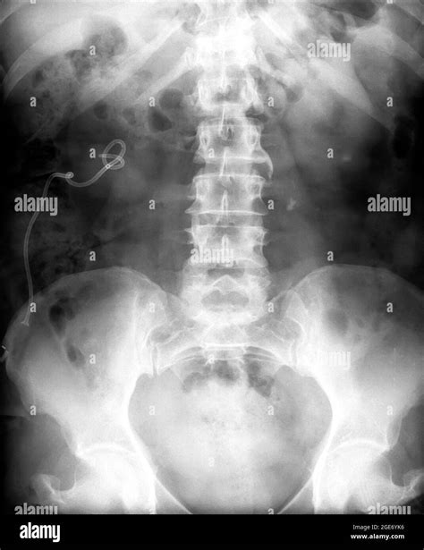 X ray normal lumbar spine hi-res stock photography and images - Alamy