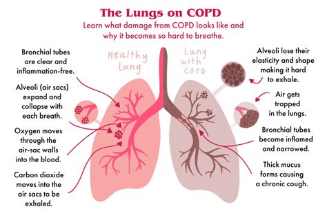 COPD: Here’s Exactly How It Affects Your Lungs