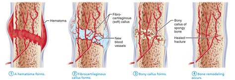 Four Stages in the Healing of a Bone Fracture