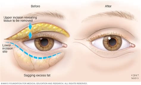 Bags under eyes Disease Reference Guide - Drugs.com