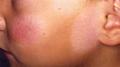 White Spots on Face: What’s Causing It?