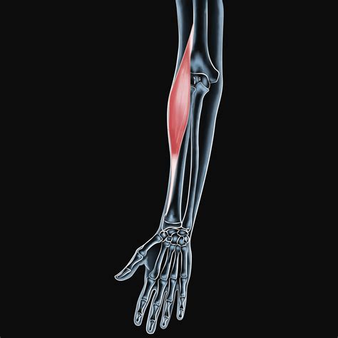 Brachioradialis Pain Relief for Active Individuals in Edmonton