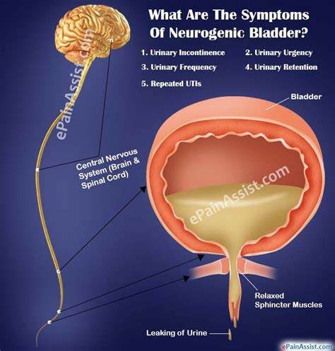 What Are The Symptoms Of Neurogenic Bladder? | Bladder incontinence ...