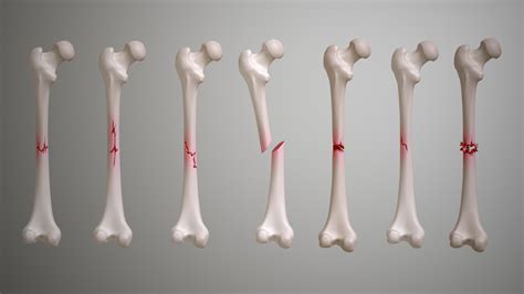 Fractures: Types, Symptoms, Causes and Treatment - Scientific Animations