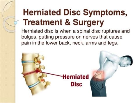 Herniated disc symptoms, treatment & surgery