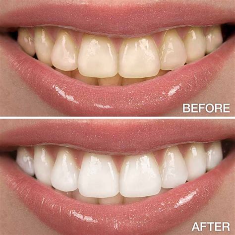 Professional Teeth Whitening in Seattle