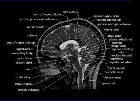 Anatomy Brainstem Mri Mri Scan Images in 2020