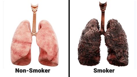 Nurse Explains What Smoking Every Day Does To Your Lungs