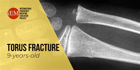 Torus Fracture - Diagnosed with ultrasound – International Emergency ...