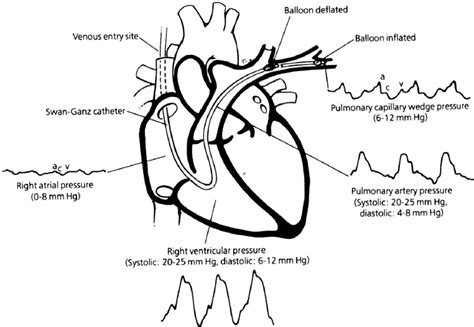 2. Pressure waveforms in PAC (from: Disease-a-month.The Swan Ganz ...