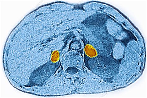 Adrenal Gland, Ct Scan - Stock Image - C024/4432 - Science Photo Library