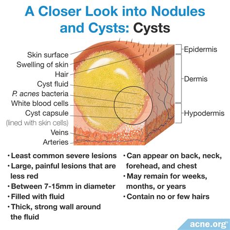 What Is Cystic Acne? - Acne.org