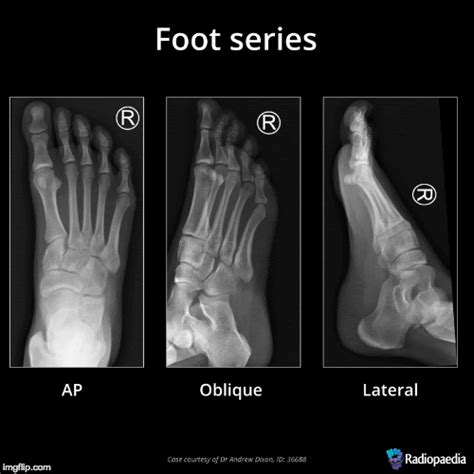 EMRad: Radiologic Approach to the Traumatic Foot X-ray