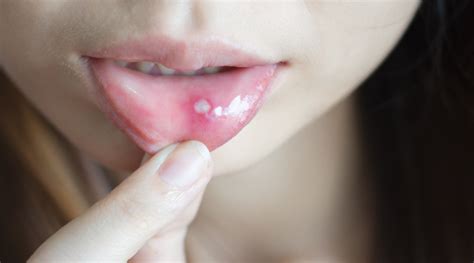 Mouth Sores: Types, Causes, Symptoms, And More - HealthKart