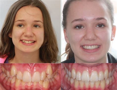 Before & After Magic, Transformational Power of Braces on Teeth