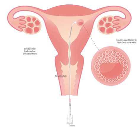 Kinderwunsch-Behandlung * Embryo-Transfer