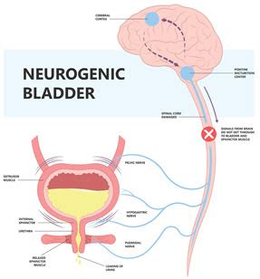 Answer 4 Questions to Solidify Neurogenic Bladder Reporting : ICD-10-CM