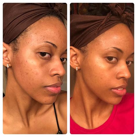 [B&A] 2 month hyperpigmentation progress: Vitamin C in the AM Personal ...