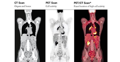 Ct Vs Pet Scan Pet Spect - chelseawinebar