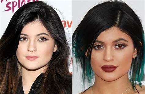 Kylie Jenner Plastic Surgery Before and After | Celebie