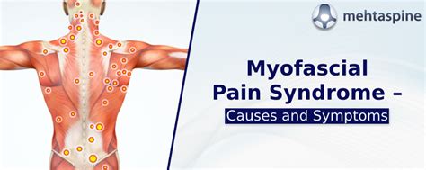 Myofascial Pain Syndrome Trigger Points Chart | Syndrome Treatment