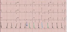 Dr. Smith's ECG Blog: AV Dissociation. Is there AV block?