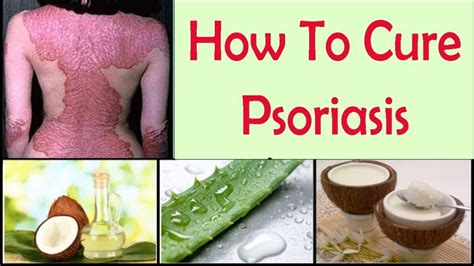 Psoriasis: 17 Natural Home Remedies