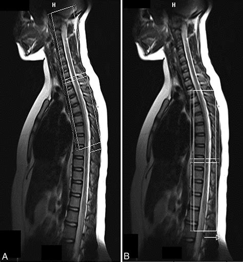 Normal Thoracic Spine Mri