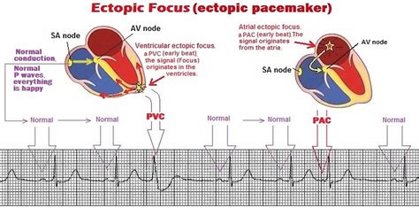 Ectopic pacemaker, beats, causes, symptoms, diagnosis, treatment ...