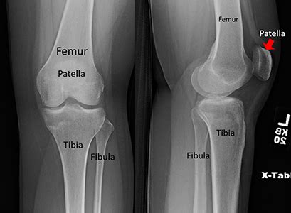 Patella Fracture (Broken Kneecap) | Orthopaedic Trauma Association (OTA)