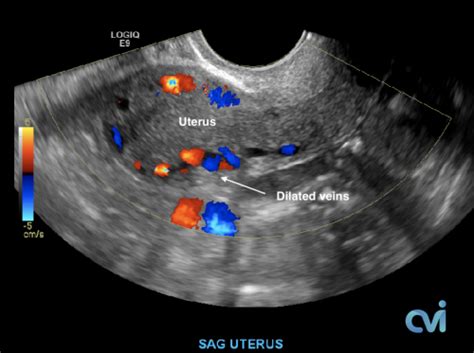 Pelvic Congestion Ultrasound