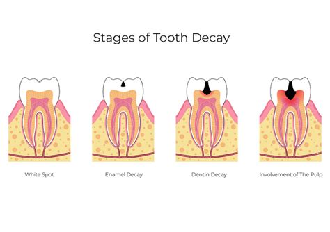 The Five Stages of a Cavity - General Dentistry | The Billings Dentist