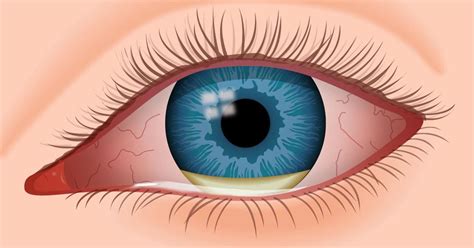 How to Tell if You Have an Eye Infection | Lockport Family Eye Care