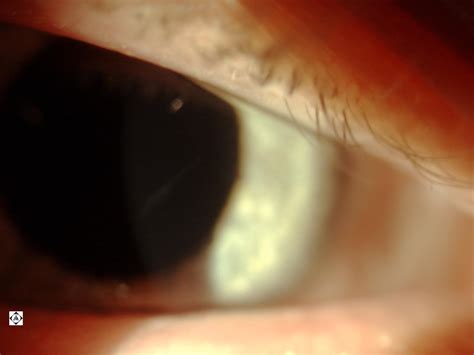 Sonoran Desert Eye Center: Cornea Scar