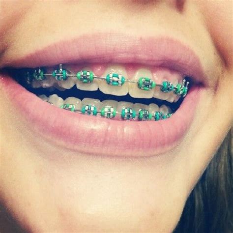 Pick your best one with the help of braces color wheel | Брекеты, Зубы