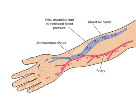 Arteriovenous Fistula(AVF) for Haemodialysis | NU Hospitals Bangalore